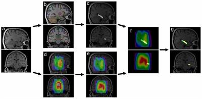 Automated ROI-Based Labeling for Multi-Voxel Magnetic Resonance Spectroscopy Data Using FreeSurfer